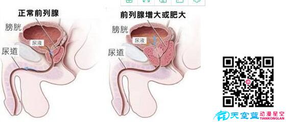 經(jīng)尿道前列腺等離子雙極電切術(shù)動(dòng)畫(huà)視頻d.jpg 經(jīng)尿道前列腺等離子雙極電切術(shù)動(dòng)畫(huà)視頻d.jpg