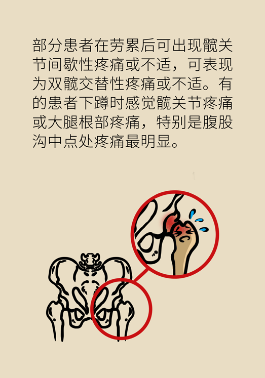激素會帶來股骨頭壞死的后遺癥嗎？