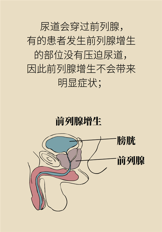前列腺肥大了還能縮小嗎？