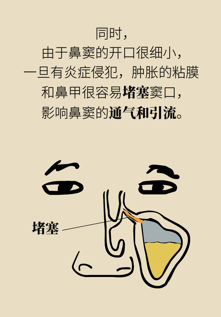 為什么鼻竇發(fā)炎，疼的卻是頭、眼和牙？