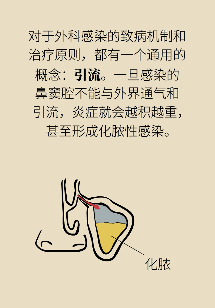 為什么鼻竇發(fā)炎，疼的卻是頭、眼和牙？
