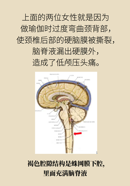 練瑜伽把腦脊液拉漏了！常見的“瑜伽病”你知道多少