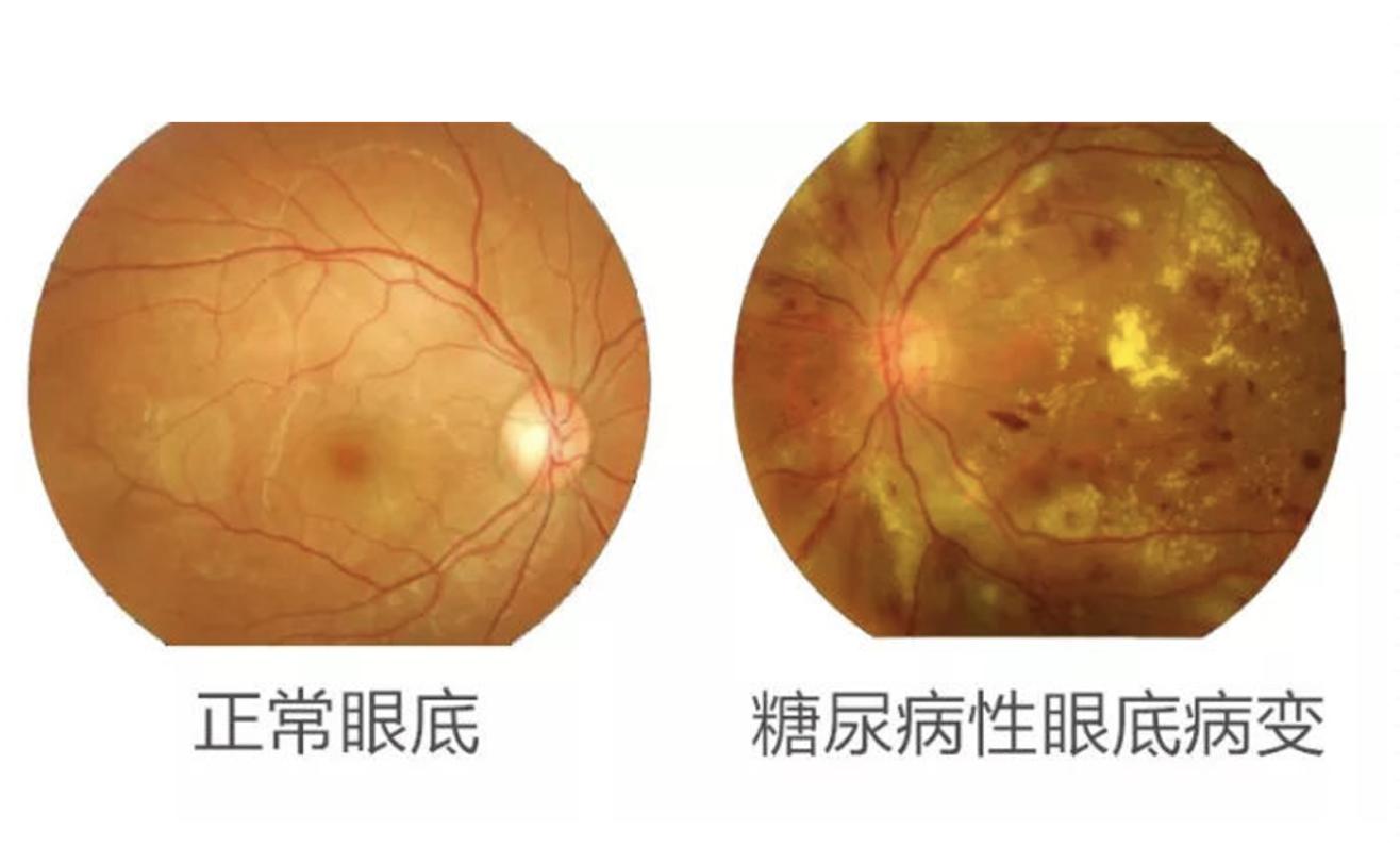 糖尿病患者出現(xiàn)這個(gè)癥狀，可能是失明前兆