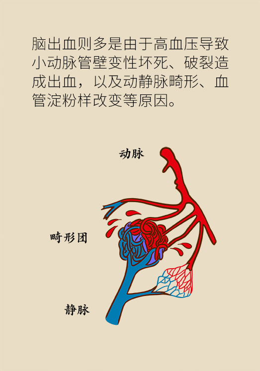 腦出血怎么辦？這些人群要格外注意