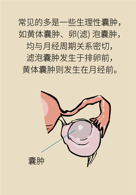 卵巢囊腫科普動漫：卵巢囊腫是腫瘤嗎？要學會這樣區(qū)分