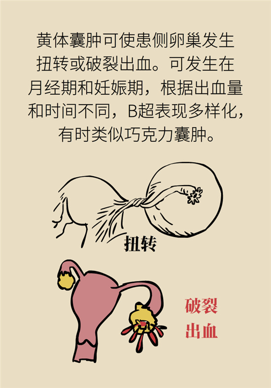 卵巢囊腫科普動漫：卵巢囊腫是腫瘤嗎？要學會這樣區(qū)分