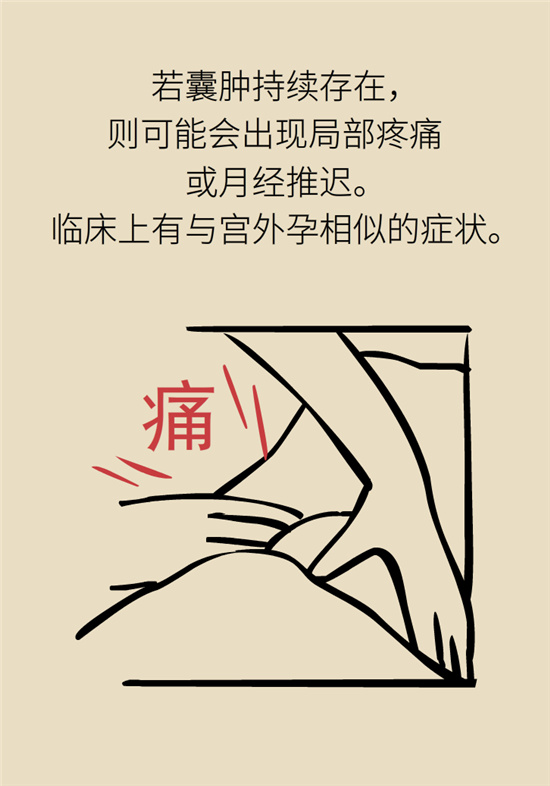 卵巢囊腫科普動漫：卵巢囊腫是腫瘤嗎？要學會這樣區(qū)分