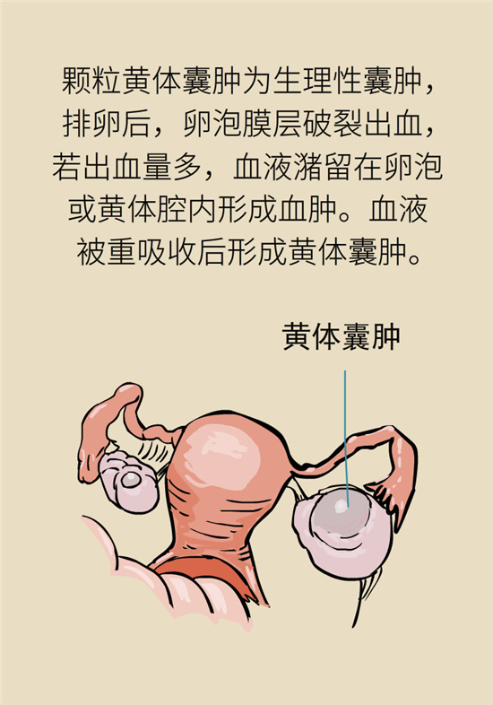 卵巢囊腫科普動漫：卵巢囊腫是腫瘤嗎？要學會這樣區(qū)分