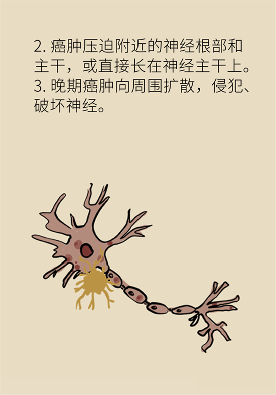 癌癥到底有多痛？需要注意這7個(gè)重點(diǎn)問(wèn)題