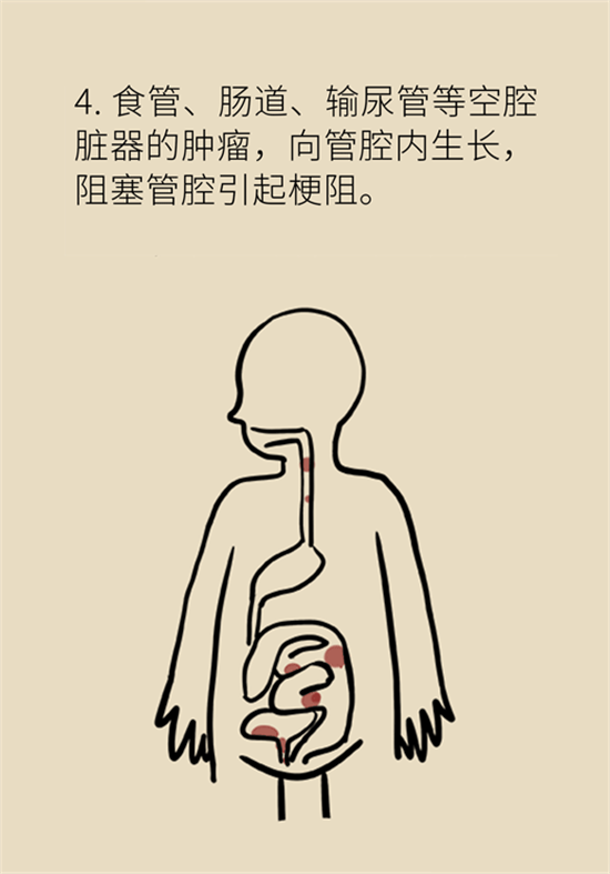 癌癥到底有多痛？需要注意這7個(gè)重點(diǎn)問(wèn)題