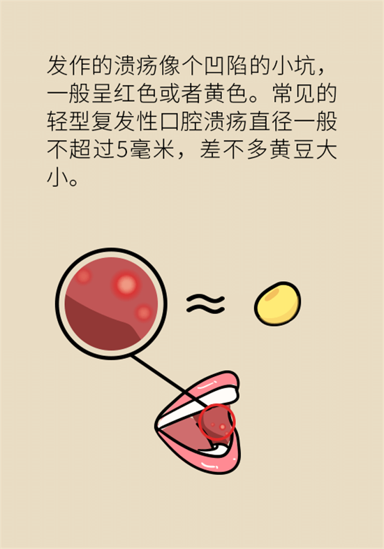 口腔潰瘍還想約火鍋？這四種情況一定要高度警惕