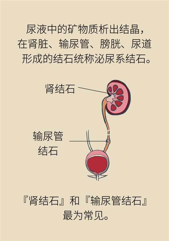 結(jié)石科普：身體里多了各種結(jié)石，應(yīng)該怎么辦？