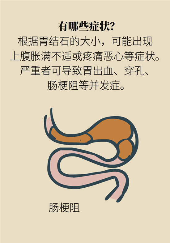結(jié)石科普：身體里多了各種結(jié)石，應(yīng)該怎么辦？