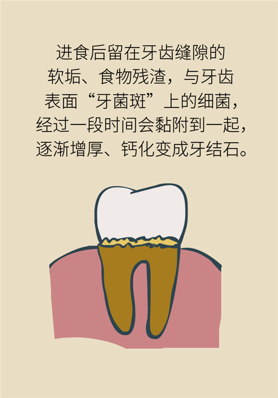 結(jié)石科普：身體里多了各種結(jié)石，應(yīng)該怎么辦？