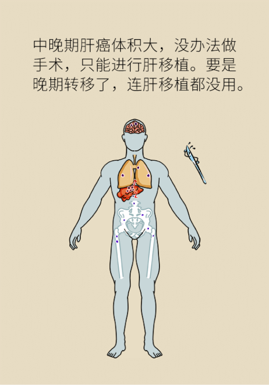 論發(fā)現(xiàn)早期肝癌的本事，cfDNA比AFP更精準(zhǔn)，比影像學(xué)更早一步