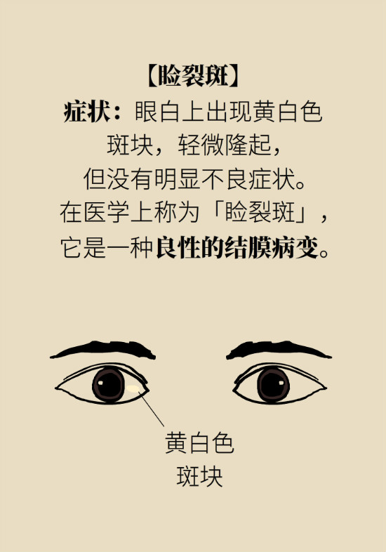 眼白有斑塊、出血要緊嗎？專家：名字唬人但問(wèn)題不大