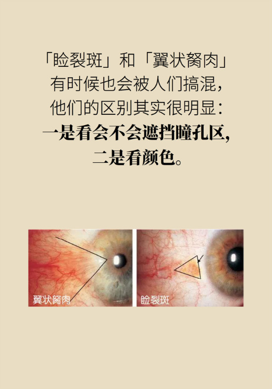 眼白有斑塊、出血要緊嗎？專家：名字唬人但問(wèn)題不大