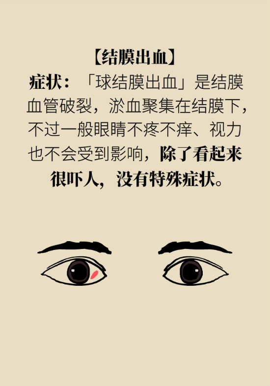 眼白有斑塊、出血要緊嗎？專家：名字唬人但問(wèn)題不大