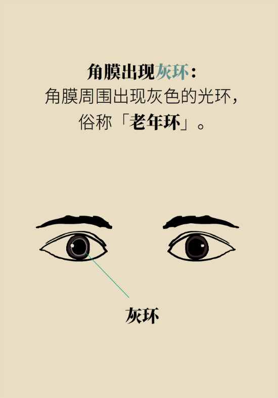 眼白有斑塊、出血要緊嗎？專家：名字唬人但問(wèn)題不大