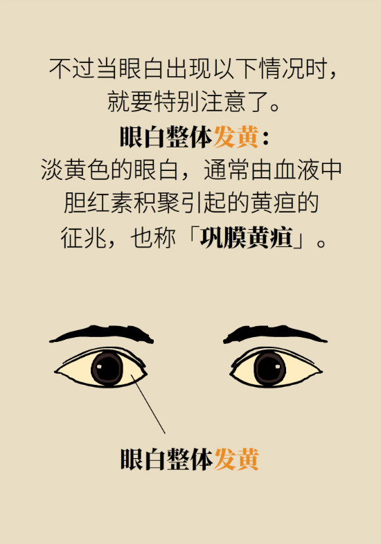 眼白有斑塊、出血要緊嗎？專家：名字唬人但問(wèn)題不大