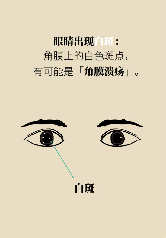 眼白有斑塊、出血要緊嗎？專家：名字唬人但問(wèn)題不大