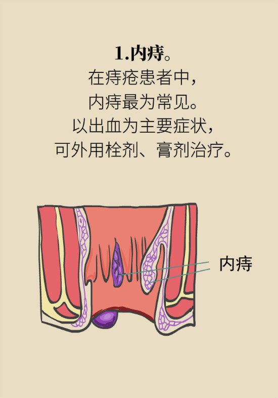 長(zhǎng)“痔”如何久安？專(zhuān)家的建議來(lái)了