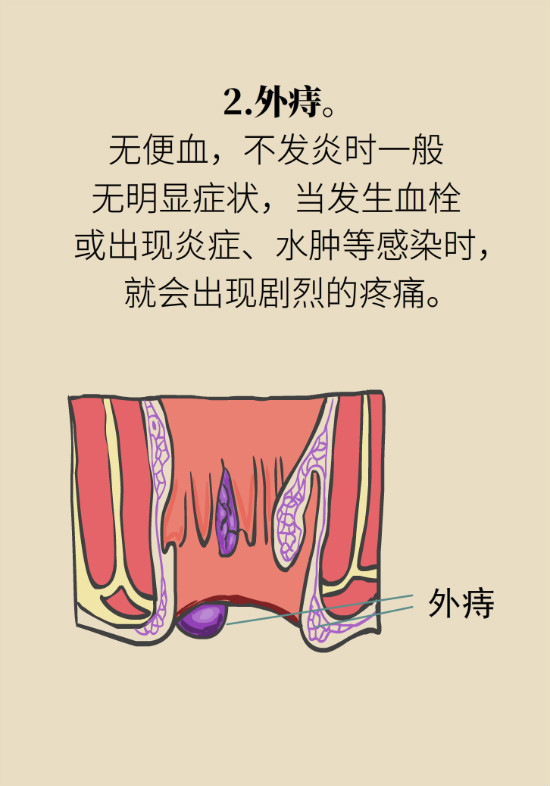 長(zhǎng)“痔”如何久安？專(zhuān)家的建議來(lái)了