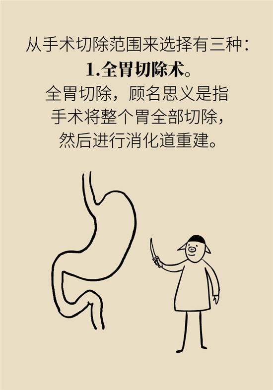胃癌手術(shù)一定要全切胃？專家：視情況而定