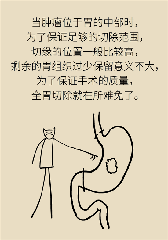 胃癌手術(shù)一定要全切胃？專家：視情況而定