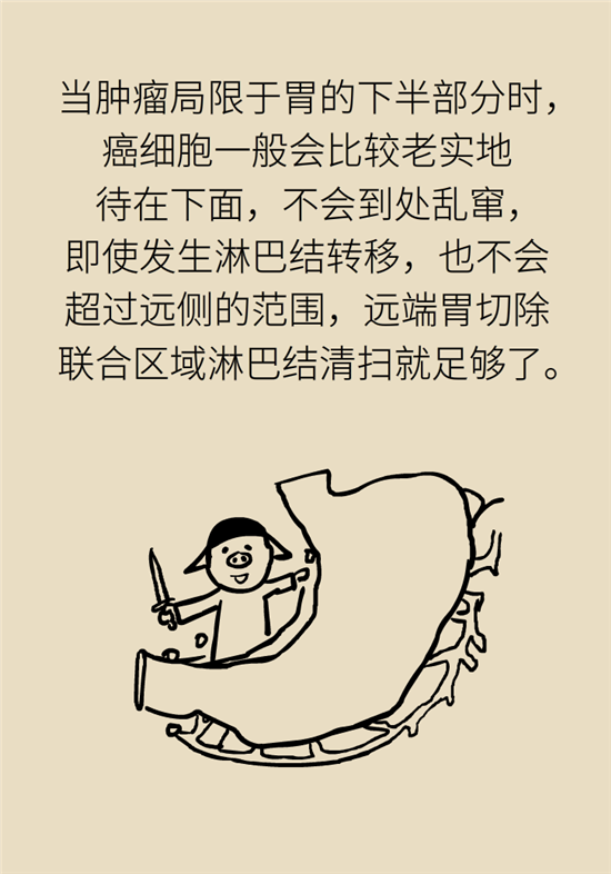 胃癌手術(shù)一定要全切胃？專家：視情況而定