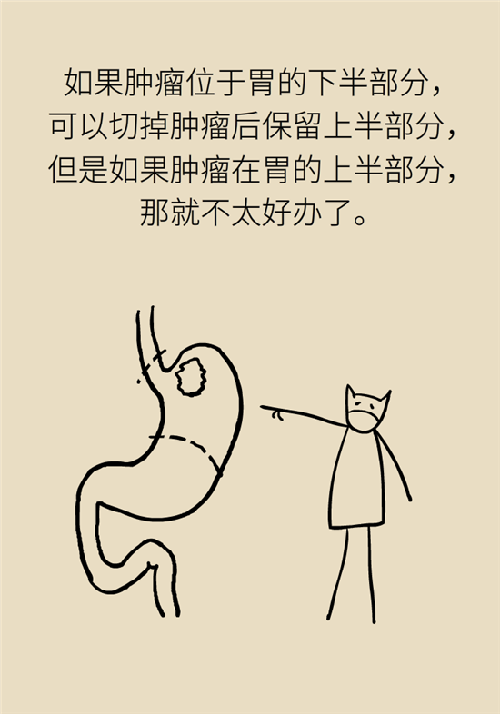 胃癌手術(shù)一定要全切胃？專家：視情況而定