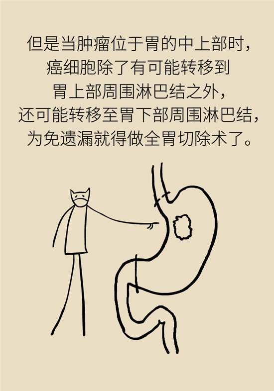 胃癌手術(shù)一定要全切胃？專家：視情況而定