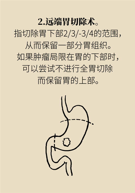 胃癌手術(shù)一定要全切胃？專家：視情況而定