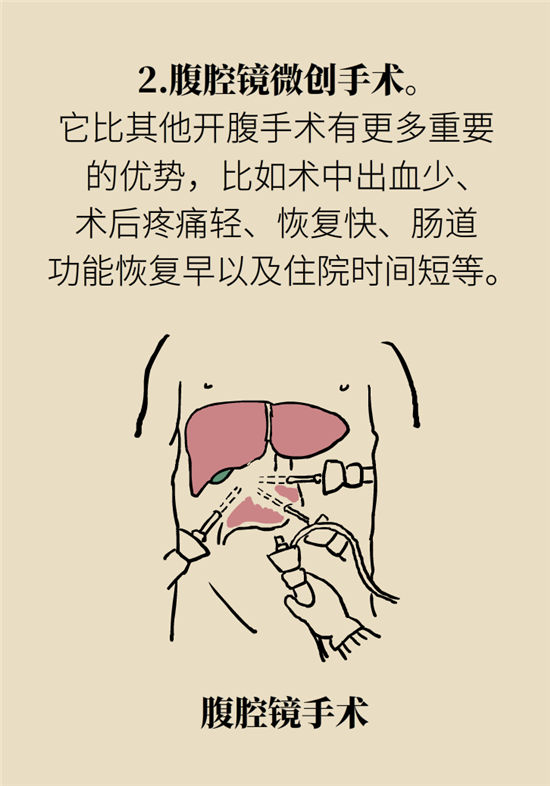 胃癌手術(shù)一定要全切胃？專家：視情況而定