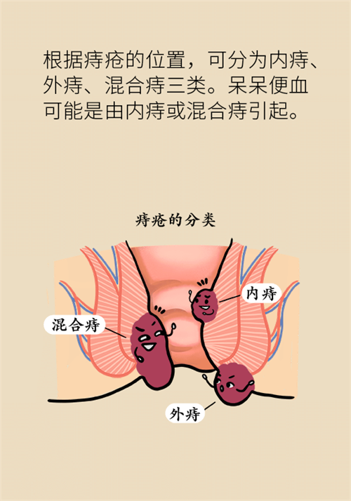 肛門腫脹還有血？小心痔瘡找上門