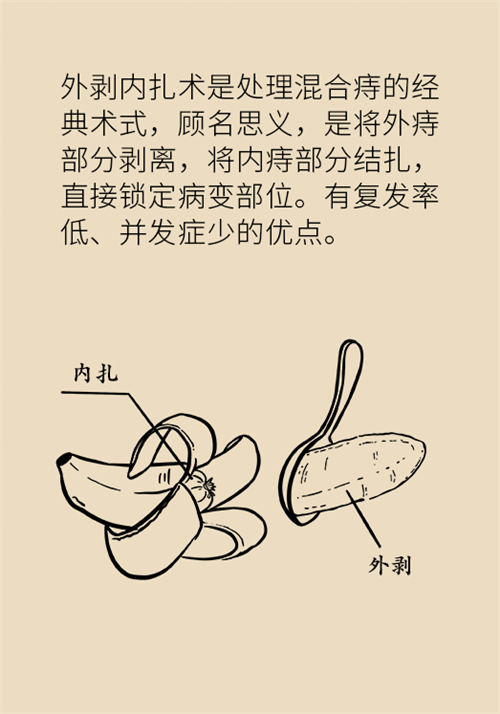 肛門腫脹還有血？小心痔瘡找上門