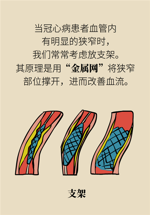 為什么裝完支架猝死風(fēng)險(xiǎn)還增高了？都是因?yàn)檫@些壞習(xí)慣