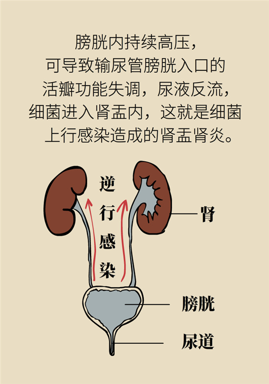 經(jīng)常憋尿會(huì)得急性腎炎？