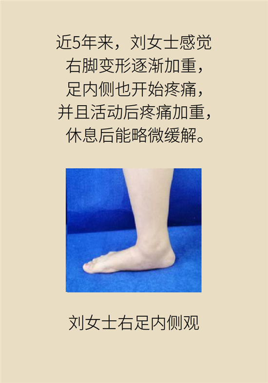 走幾百米路就疼得不行了？可能患上了平足癥