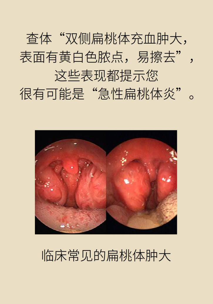 單側(cè)扁桃體腫大更兇險！謹(jǐn)防惡性腫瘤