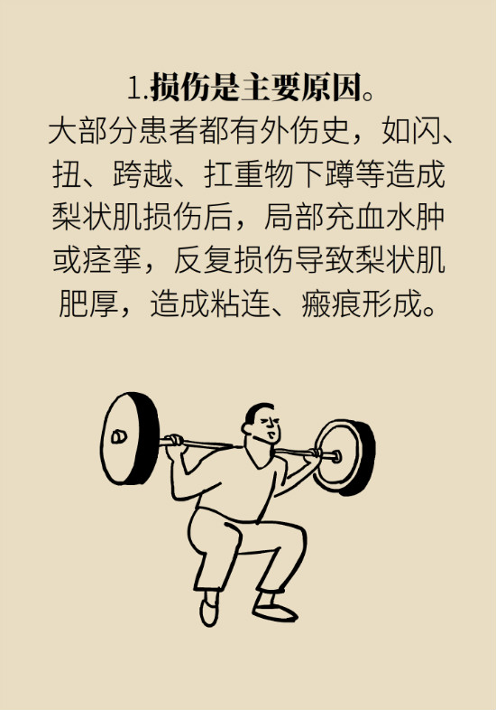 梨狀肌綜合征 梨狀肌綜合征