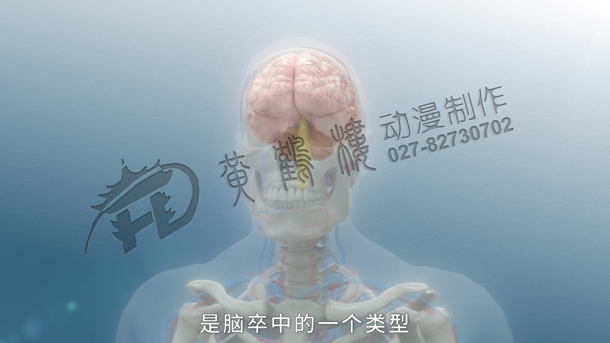 《缺血性腦卒中》三維醫(yī)療科普動(dòng)畫(huà)宣傳片 《缺血性腦卒中》三維醫(yī)療科普動(dòng)畫(huà)宣傳片