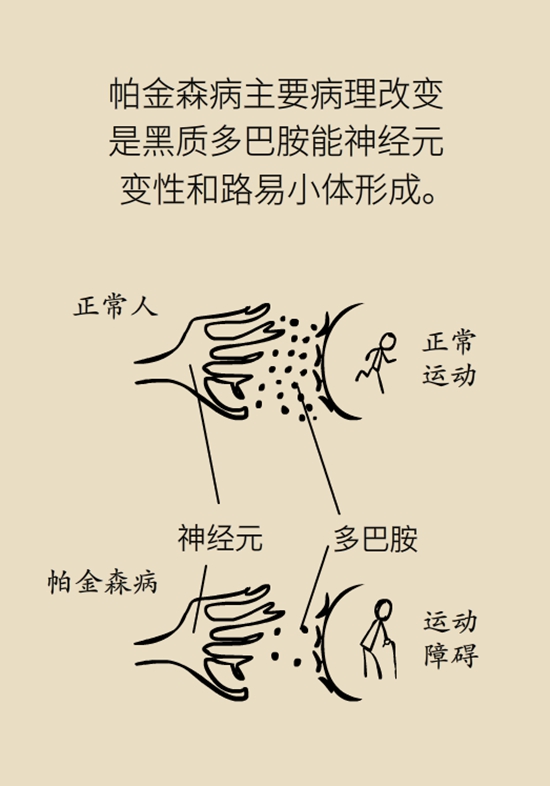 醫(yī)療動(dòng)畫(huà)帕金森病科普