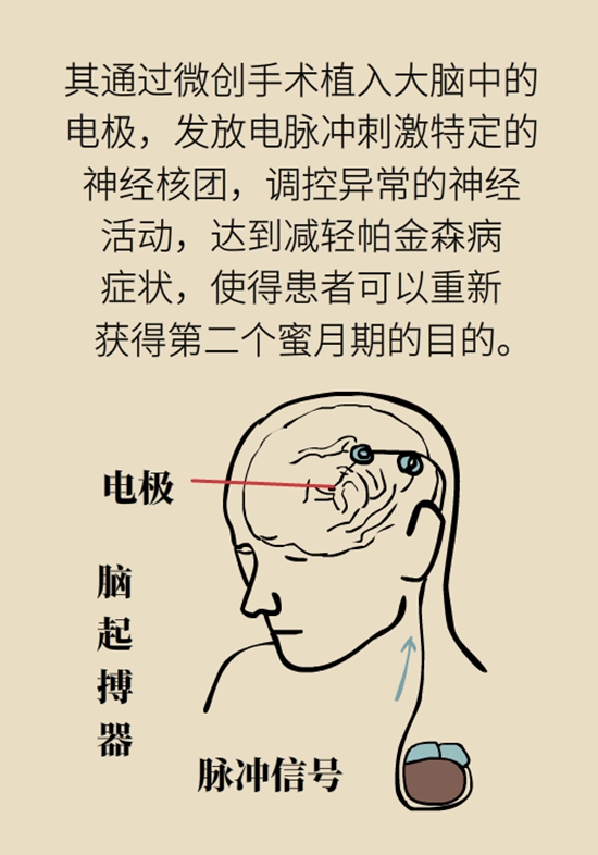 醫(yī)療動(dòng)畫(huà)帕金森病科普