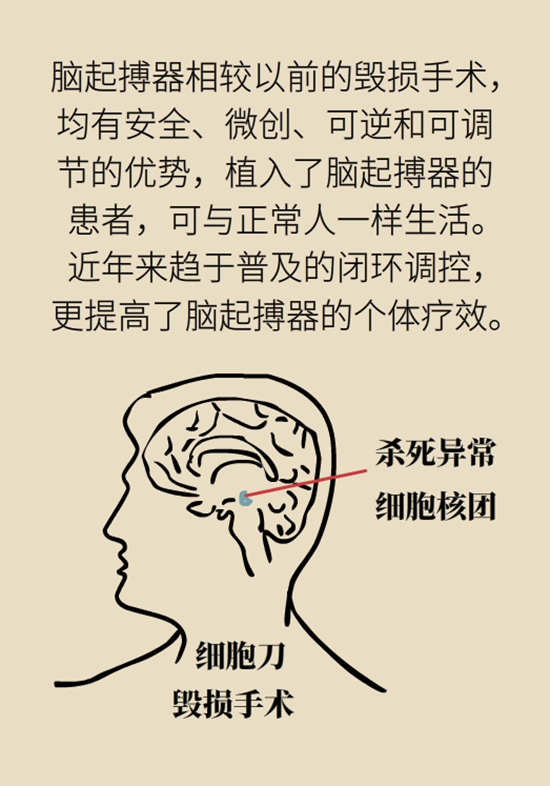 醫(yī)療動(dòng)畫(huà)帕金森病科普
