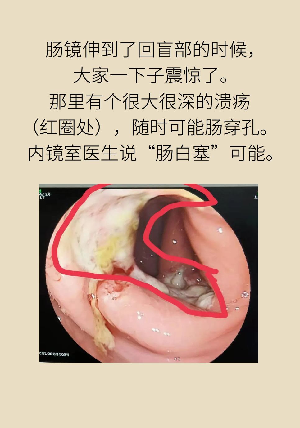 長(zhǎng)白塞病醫(yī)學(xué)知識(shí)科普動(dòng)畫(huà)制作