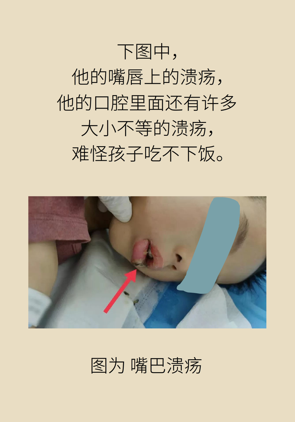 長(zhǎng)白塞病醫(yī)學(xué)知識(shí)科普動(dòng)畫(huà)制作