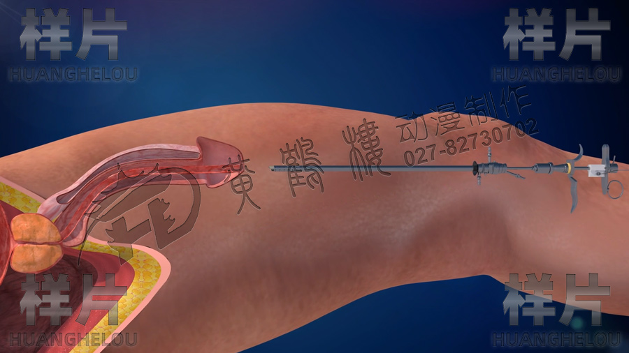前列腺手術(shù)動(dòng)畫(huà)視頻 前列腺手術(shù)動(dòng)畫(huà)視頻
