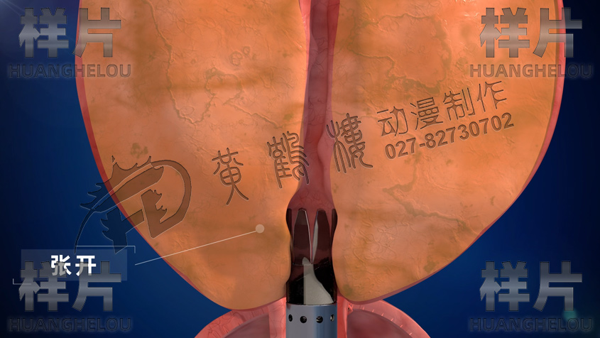 電刀保護(hù)鞘插入.jpg 電刀保護(hù)鞘插入.jpg