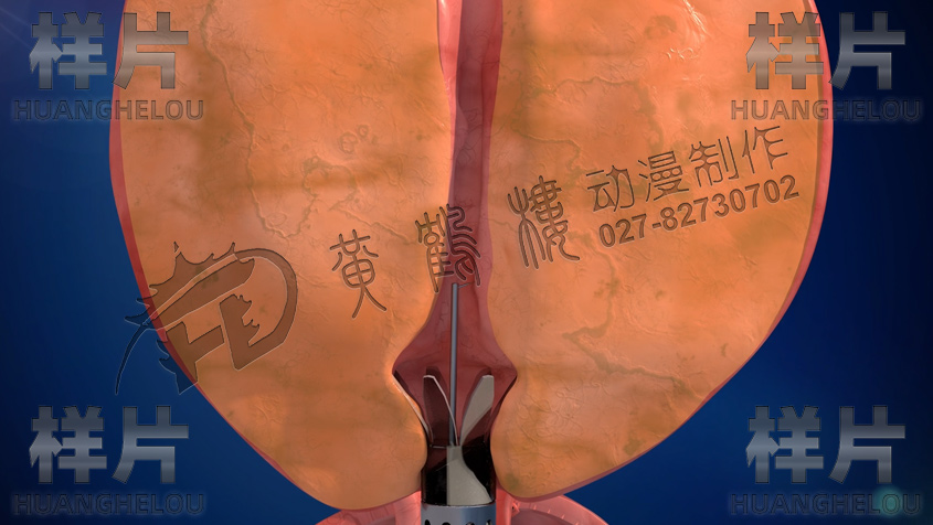 尿道保護(hù)鞘張開.jpg 尿道保護(hù)鞘張開.jpg